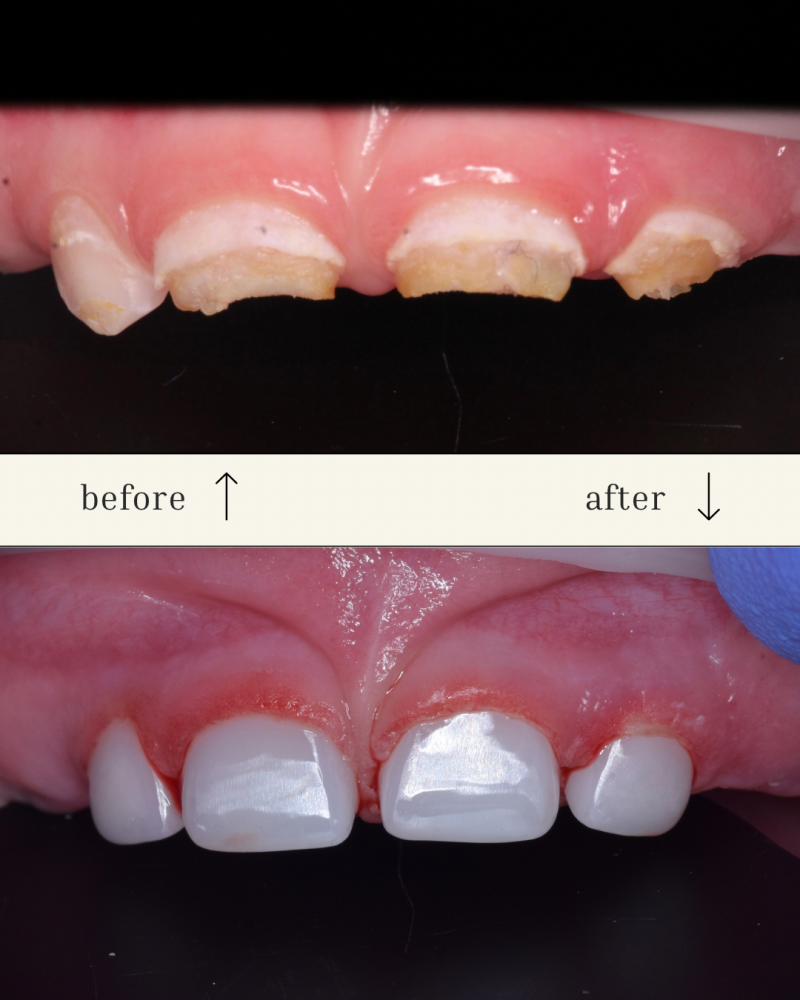 The image shows teeth before and after a dental procedure; the top panel displays teeth with damage and discoloration, labeled 'before' with an upward arrow, and the bottom panel shows the same teeth restored with white fillings, labeled 'after' with a downward arrow.