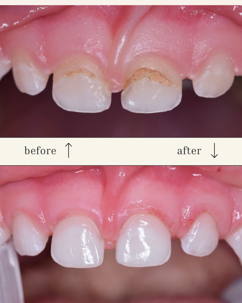 The image shows a before-and-after comparison of teeth, with the top image displaying teeth with visible damage and the bottom image showing the same teeth after repair.