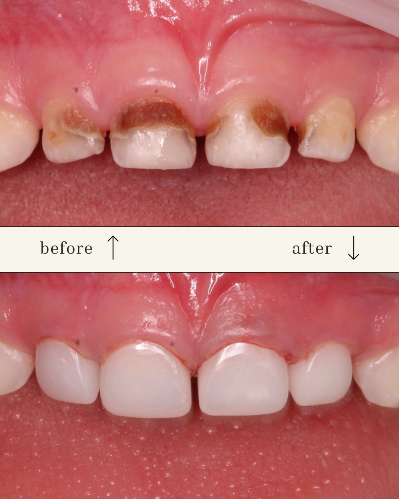 The image shows a before-and-after view of teeth, with the top image showing decayed teeth and the bottom image showing healthy, white teeth; text reads 'before' with an upward arrow and 'after' with a downward arrow.