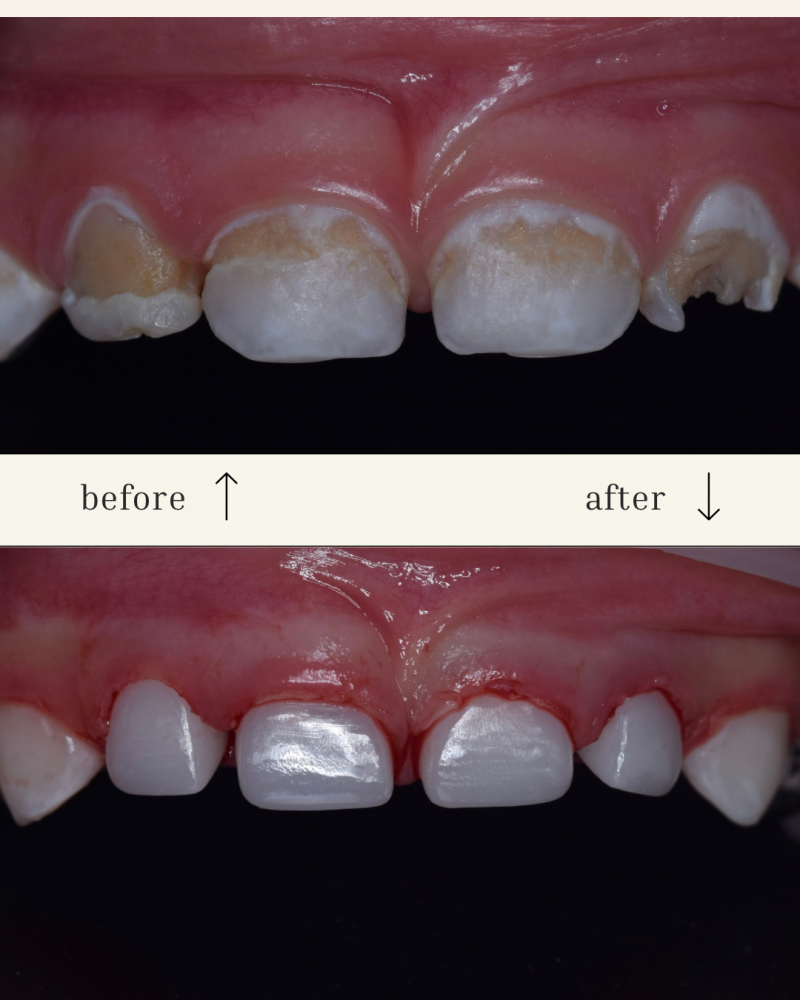 The image shows a before-and-after comparison of teeth, with the 'before' image displaying decayed and damaged teeth and the 'after' image showing teeth that have been repaired and whitened.