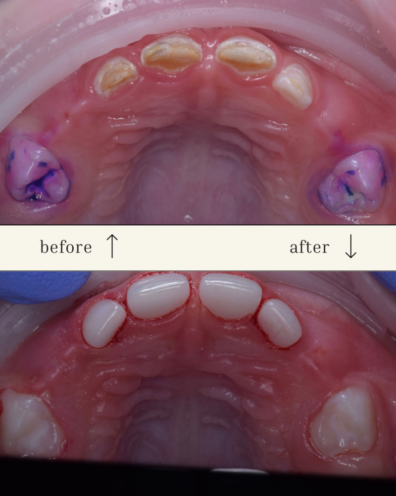 The image shows before-and-after dental work on a set of upper teeth, with the 'before' picture displaying discolored teeth and blue markings on the molars, while the 'after' picture showcases a set of bright white teeth.