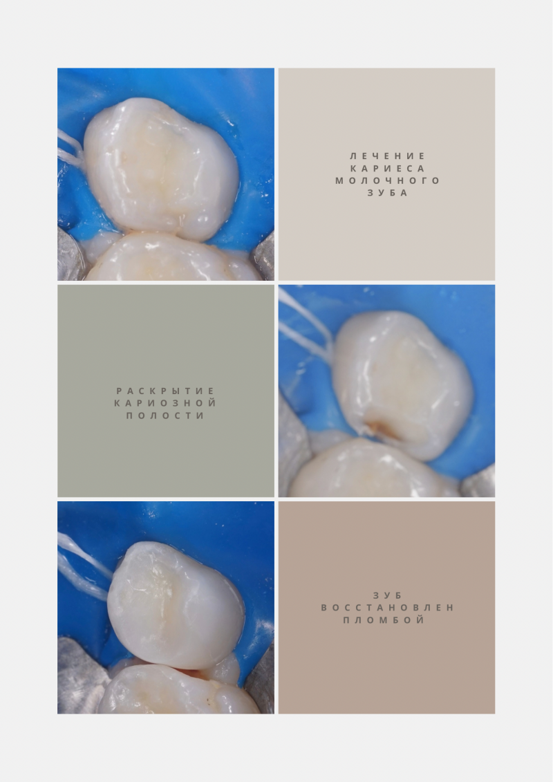 The image shows a collage of dental procedures with text blocks. The text includes phrases like 'Treatment of caries of a milk tooth', 'Opening of a carious cavity', and 'Tooth restored with filling'.