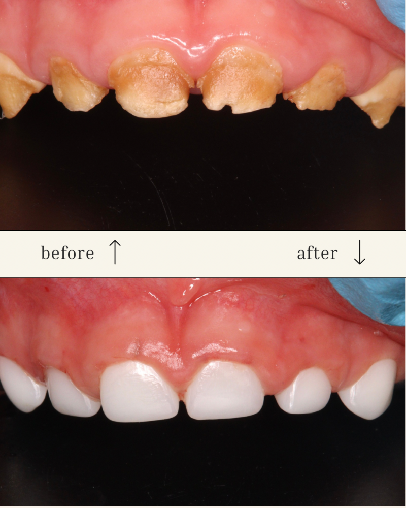 The image shows a before-and-after comparison of dental restoration, with the upper image displaying heavily damaged, yellowed teeth and the lower image showing a set of restored, white teeth. Above each image are the words "before" and "after" with an arrow pointing at the corresponding teeth.