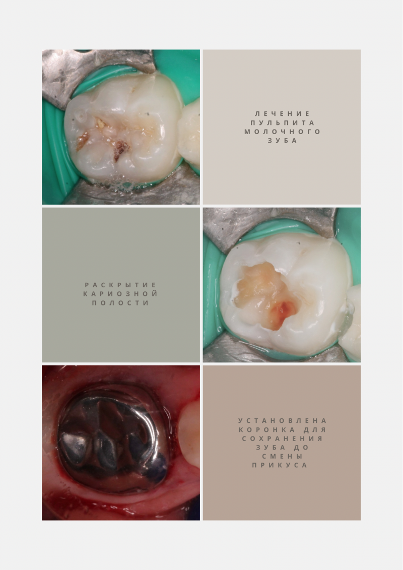The image is a collage of six squares showing stages of dental treatment: before treatment with tooth decay, after cavity cleaning, and after crown placement. Text in Russian is included: 'Treatment of pulpitis of a milk tooth', 'Opening of a carious cavity', and 'A crown has been installed to preserve the tooth until the bite changes'.